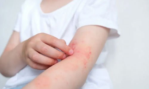 Skin rashes in babies